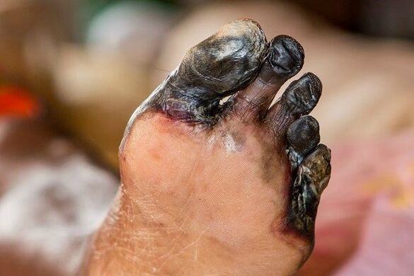 Gangreno dos dedos dos pés no diat